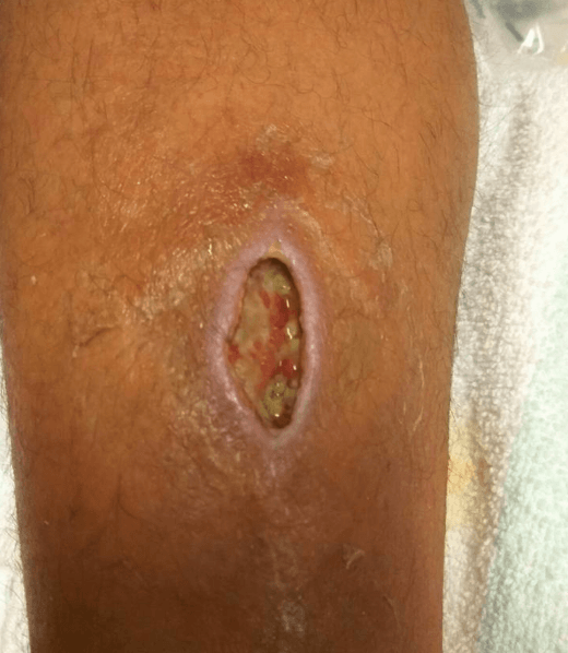 Herida por bacteria de la Restinga