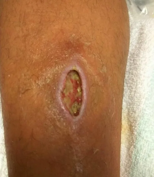 Herida por bacteria de la Restinga