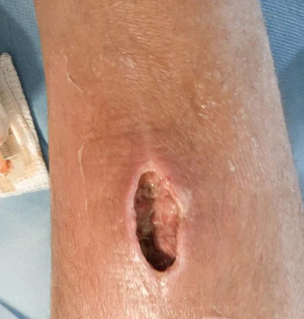 Herida causada por una bacteria, buceando