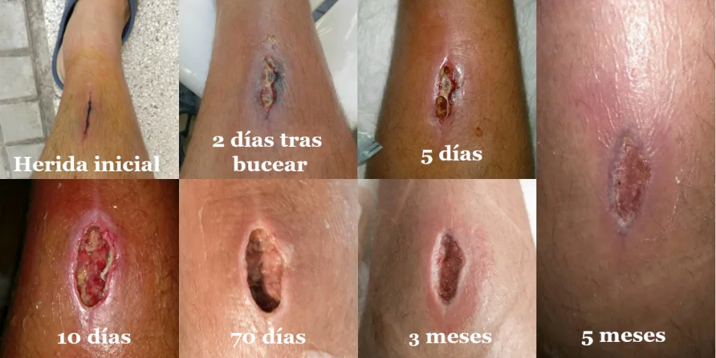Evolución de esta herida de buceo